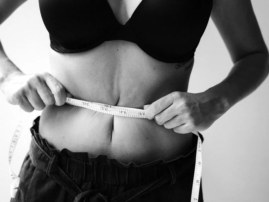Abdominoplastia